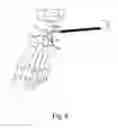 Fig. 05 - Surgical instrument and method for use in sizing fixation implants