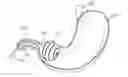 Fig. 01 - Locking gastric obstruction device and method of use