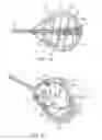 Fig. 12 - Locking gastric obstruction device and method of use
