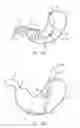 Fig. 19 - Locking gastric obstruction device and method of use
