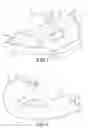 Fig. 03 - Custom-fit dental guard