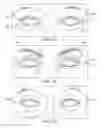 Fig. 17 - Dry eye treatment systems