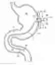 Fig. 01 - Double Lumen Integrated Enteral Feeding Assembly and a Method for Use Thereof