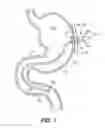 Fig. 02 - Double Lumen Integrated Enteral Feeding Assembly and a Method for Use Thereof