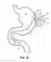 Fig. 07 - Double Lumen Integrated Enteral Feeding Assembly and a Method for Use Thereof
