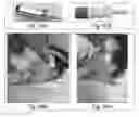 Fig. 76 - Device and method for aerosolized delivery of substance to a natural orifice of the body