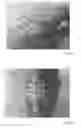 Fig. 09 - Stabilization devices for vascular access and methods of using the same