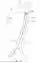 Fig. 09 - Helical balloon catheter
