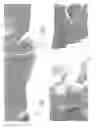 Fig. 07 - HERMETIC IMPLANTABLE SENSOR