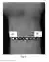 Fig. 05 - System and method to collect gesture input through wrist tendon and muscle sensing