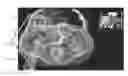 Fig. 01 - In-context photorealistic 3D visualization for surgical decision support