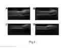Fig. 06 - Optical tomography digital impression imaging system and method for use thereof