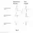 Fig. 03 - Method and apparatus for analysing changes in the electrical activity of a patient's heart in different states