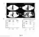 Fig. 05 - Method and apparatus for analysing changes in the electrical activity of a patient's heart in different states