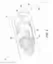 Fig. 03 - Positioning tool for an orthopedic implant