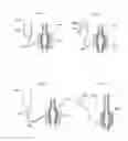 Fig. 03 - Device for treatment of aneurysm
