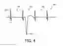 Fig. 03 - Static charge filter for cardiac electrical signals corrupted with static charge and routed to an electrocardiograph (EKG) monitor