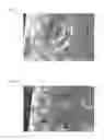 Fig. 05 - Echogenic article with compound indentations