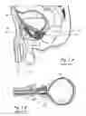 Fig. 02 - Devices, systems and methods for treating benign prostatic hyperplasia and other conditions
