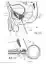 Fig. 04 - Devices, systems and methods for treating benign prostatic hyperplasia and other conditions