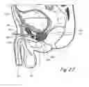 Fig. 05 - Devices, systems and methods for treating benign prostatic hyperplasia and other conditions
