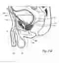Fig. 06 - Devices, systems and methods for treating benign prostatic hyperplasia and other conditions