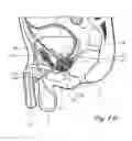 Fig. 07 - Devices, systems and methods for treating benign prostatic hyperplasia and other conditions