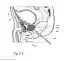 Fig. 08 - Devices, systems and methods for treating benign prostatic hyperplasia and other conditions