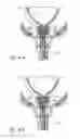 Fig. 11 - Devices, systems and methods for treating benign prostatic hyperplasia and other conditions
