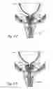 Fig. 12 - Devices, systems and methods for treating benign prostatic hyperplasia and other conditions