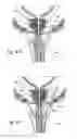 Fig. 13 - Devices, systems and methods for treating benign prostatic hyperplasia and other conditions