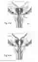 Fig. 14 - Devices, systems and methods for treating benign prostatic hyperplasia and other conditions