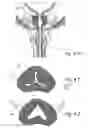 Fig. 16 - Devices, systems and methods for treating benign prostatic hyperplasia and other conditions