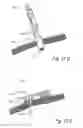 Fig. 25 - Devices, systems and methods for treating benign prostatic hyperplasia and other conditions