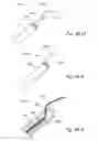 Fig. 38 - Devices, systems and methods for treating benign prostatic hyperplasia and other conditions