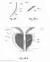Fig. 40 - Devices, systems and methods for treating benign prostatic hyperplasia and other conditions