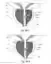 Fig. 41 - Devices, systems and methods for treating benign prostatic hyperplasia and other conditions