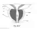Fig. 42 - Devices, systems and methods for treating benign prostatic hyperplasia and other conditions