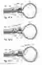 Fig. 44 - Devices, systems and methods for treating benign prostatic hyperplasia and other conditions