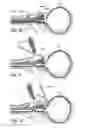 Fig. 45 - Devices, systems and methods for treating benign prostatic hyperplasia and other conditions