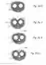 Fig. 51 - Devices, systems and methods for treating benign prostatic hyperplasia and other conditions