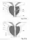 Fig. 52 - Devices, systems and methods for treating benign prostatic hyperplasia and other conditions