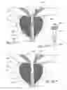Fig. 55 - Devices, systems and methods for treating benign prostatic hyperplasia and other conditions