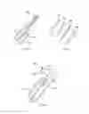 Fig. 14 - Tissue compression device for cardiac valve repair