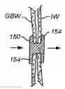Fig. 01 - Tissue anchor for securing tissue layers