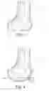 Fig. 03 - Methods and apparatus for performing knee arthroplasty