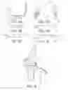 Fig. 05 - Methods and apparatus for performing knee arthroplasty