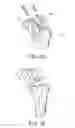 Fig. 16 - Methods and apparatus for performing knee arthroplasty