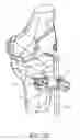 Fig. 28 - Methods and apparatus for performing knee arthroplasty