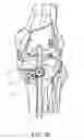 Fig. 29 - Methods and apparatus for performing knee arthroplasty